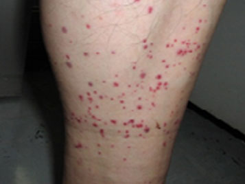 トコジラミ(南京虫)